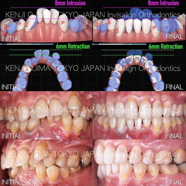 新しい出会いの季節 歯並びで自信の笑顔に インビザライン 本郷さくら矯正歯科 スマイルイノベーション矯正歯科 笑顔 スマイル モデル モデル募集 モニター Ojima Kenji Snapwidget