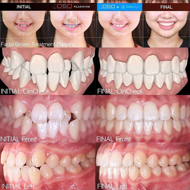 10代のインビザライン矯正治療 歯を抜かずに矯正治療が終わりました インビザライン インビザライン終了おめでとうございます 子供 子ども 子供矯正 歯並び 笑顔 小顔 スマイル 小児矯正 キッズ キッズモデル キッズモニターモデル募集 モデル モニター